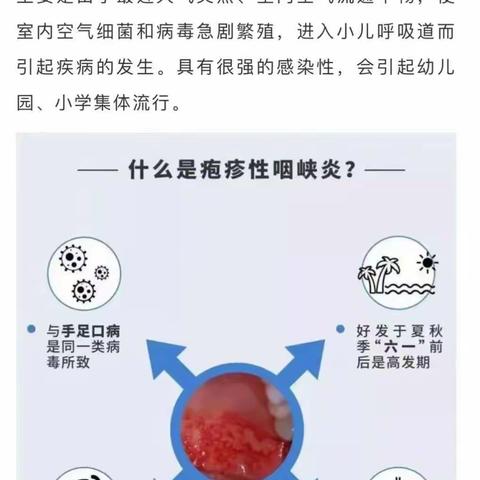 疱疹性咽峡炎高发！别慌，有效预防不可怕！