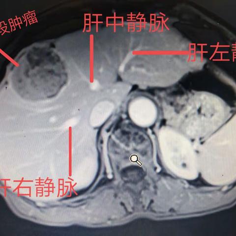 一例中肝癌病例分享