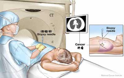 “针尖上的舞者”---长治市人民医院肿瘤中心微创小组成功实施CT引导下经皮穿刺活检术