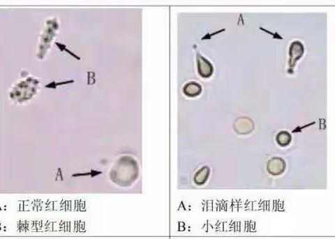 尿沉渣形态及临床意义大汇总