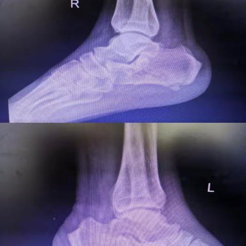 双跟骨骨折