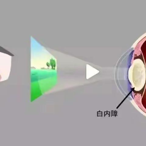 【第四社区】“光明救助”之白内障复明活动