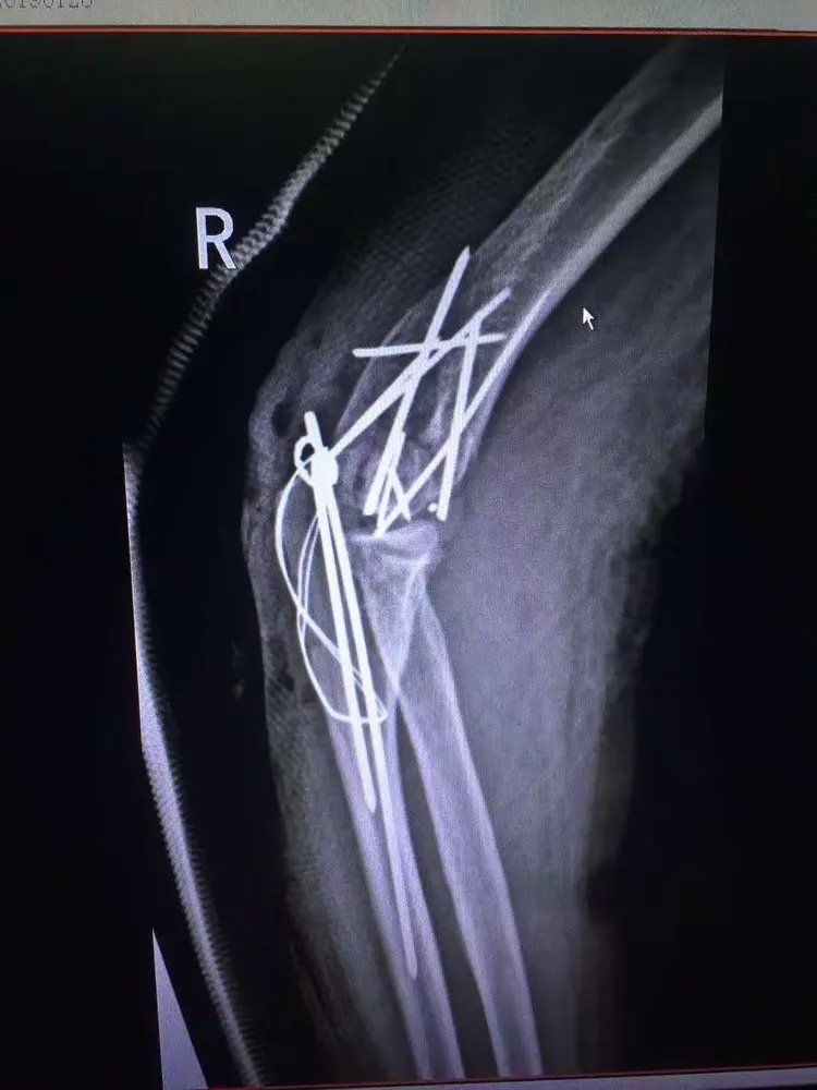 右肱骨内外髁骨折