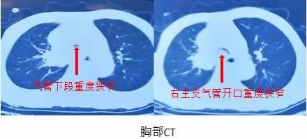 双节将至 国之盛庆︱“136”兴医工程山医大一院呼吸与危重症医学科完成一例气道Y型支架置入术