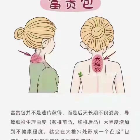 有了富贵包就是颈椎病吗？