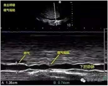 下腔静脉宽度及变异度（塌陷率）的超声测量