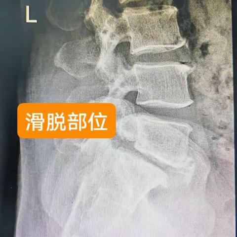 婺源天佑医院腰椎滑脱精准治疗