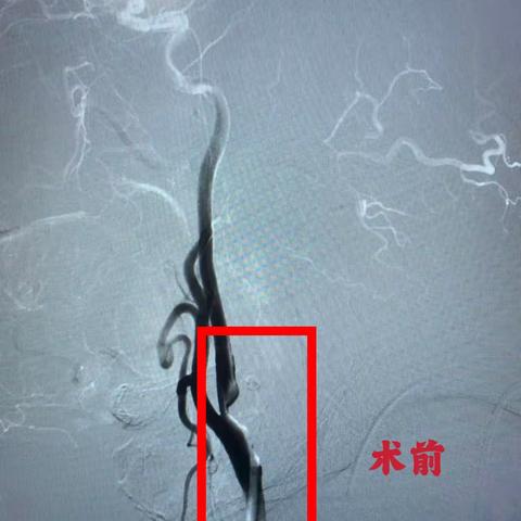 脑血管介入治疗——脑血管支架成形术