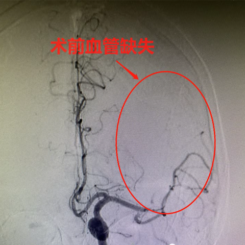 神经介入取栓———精准狙击，拯救大脑