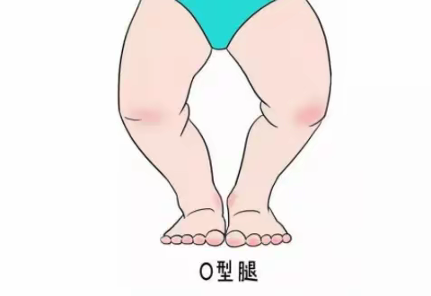 科普 I 宝宝腿不直要治疗吗？