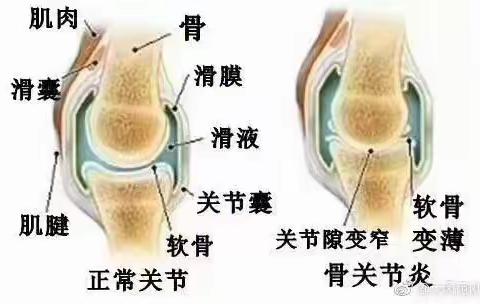 骨关节炎