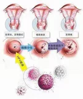 宫颈癌筛查知多少