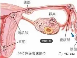 六医妇科科普（二）之急腹症—“宫外孕”