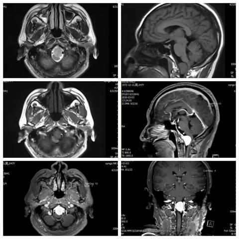 枕骨大孔区脑膜瘤病例分享