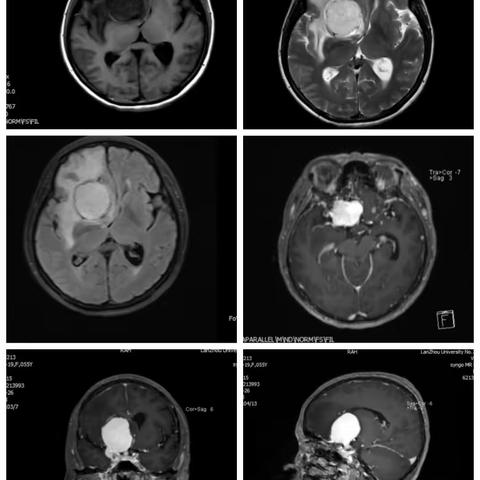 内侧型蝶骨嵴脑膜瘤病例分享