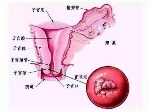 两癌一筛