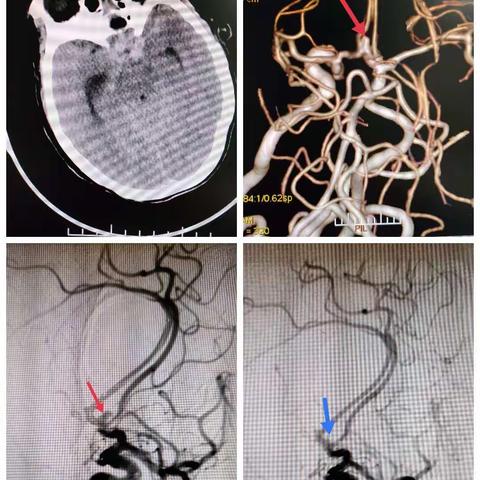 动脉瘤病例