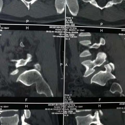 孙海亮 男 31岁 腰5峡部裂伴椎体滑脱