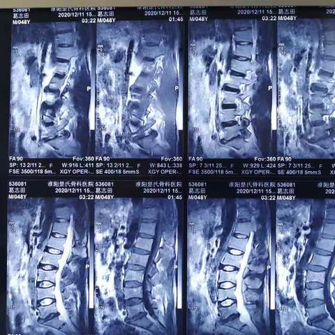 葛志田  男   48岁   L5/S1椎间盘突出症