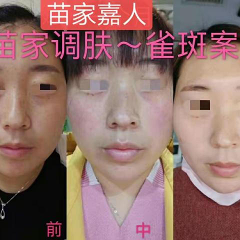 你脸上的黑斑，你发愁吗?