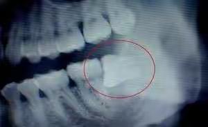 智齿总是发炎，什么时候拔了好