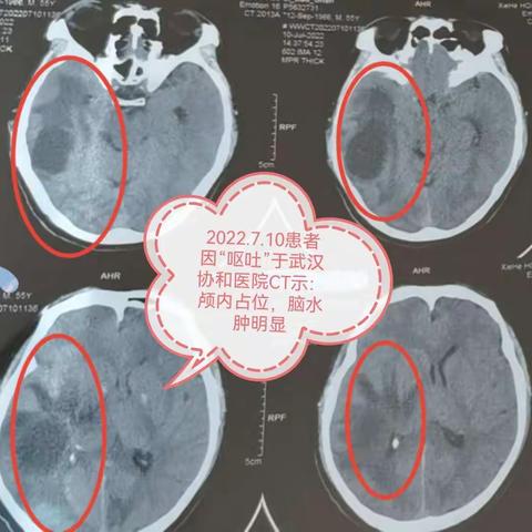 一例肺腺癌脑转移经典病例分享