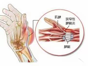 小切口治疗狭窄性腱鞘炎—华宁瑞仁医院手足外科（外二科）