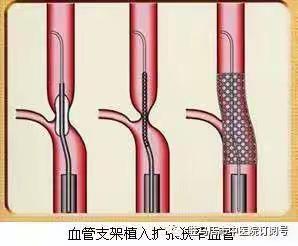 介入支架植入术 让脑血管畅通无"阻"