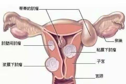 子宫肌瘤，谁割谁后悔，其中的原因是....