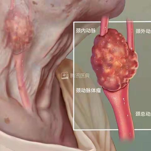 晋中三院神经外科一例颈动脉体瘤罕见病例根治报道