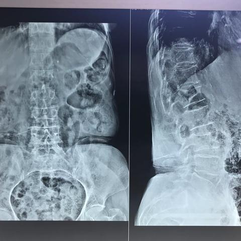艺高“胆”大是为了患者