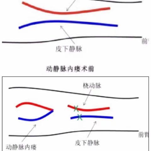 今天的内瘘操你锻炼了吗？