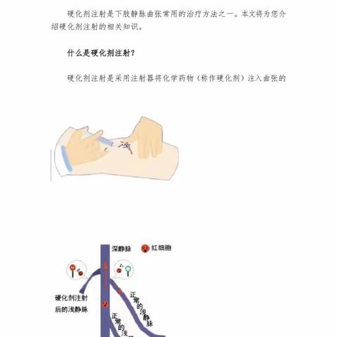 硬化剂注射治疗下肢静脉曲张