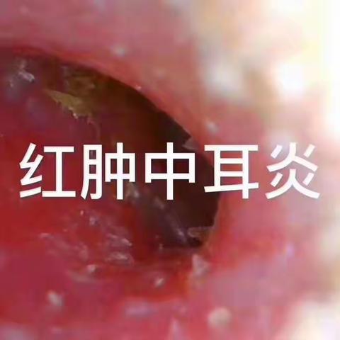 中耳炎症状和修复方法