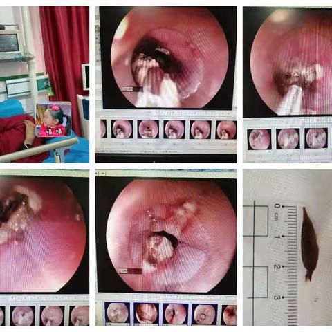 紧急胃镜下异物探取——善堂中心卫生院