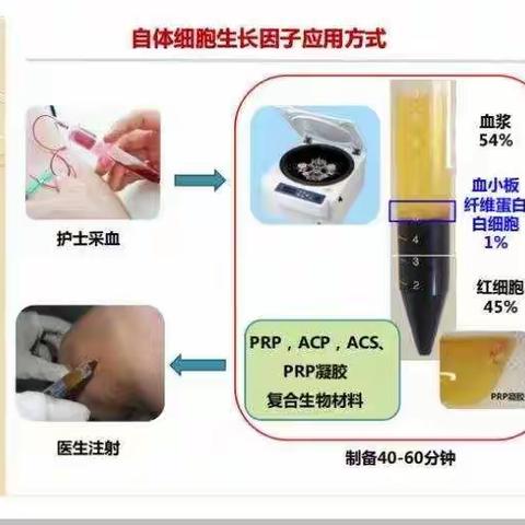 延缓关节衰退新疗法----  PRP