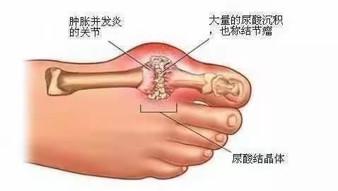 痛风良药_车前草