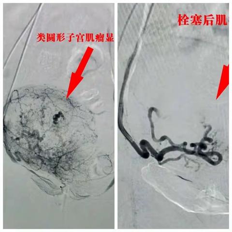 神火集团职工总医院介入团队陈朋储文轩