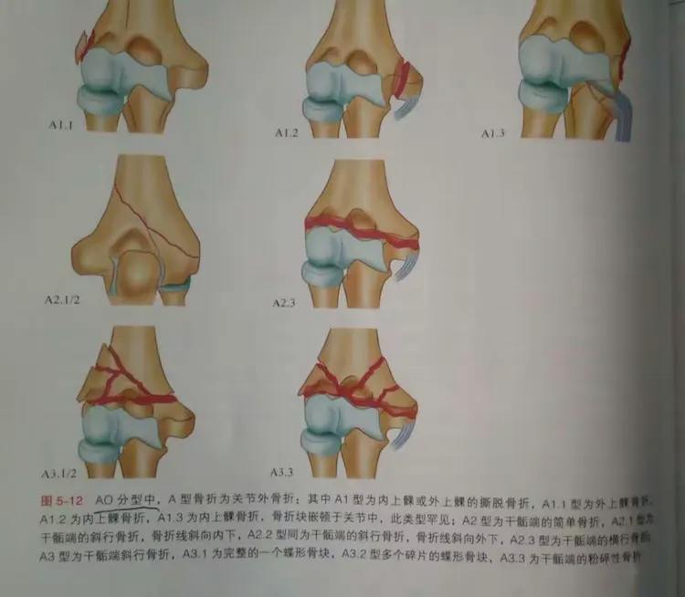 肱骨远端骨折