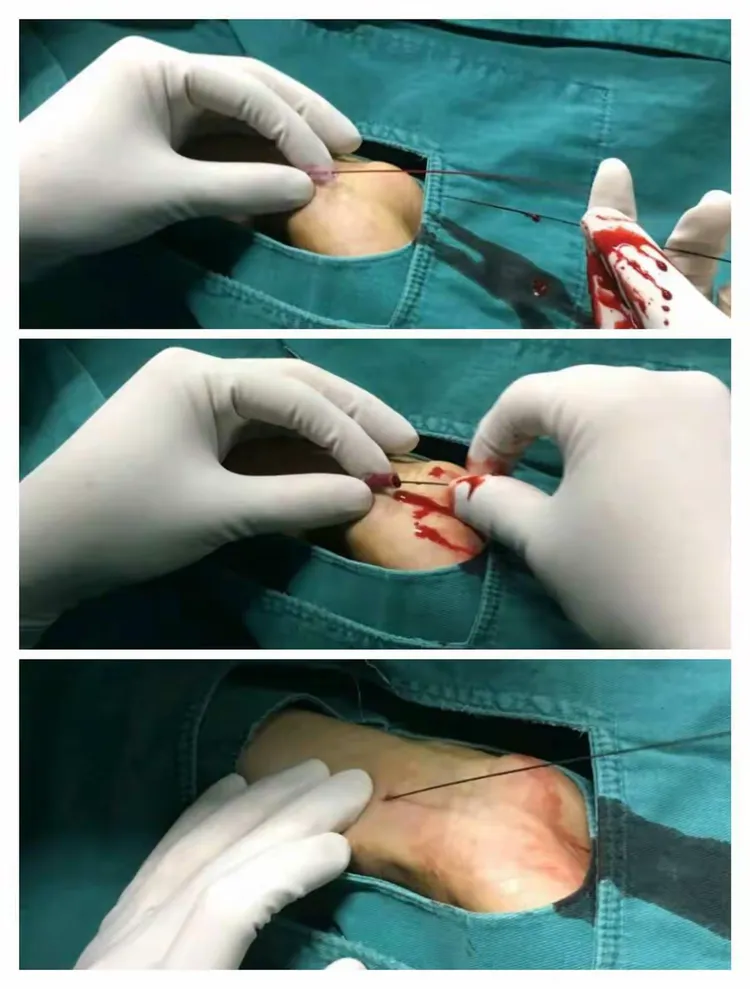 積水潭醫(yī)院預(yù)約助手穿刺預(yù)約-積水潭醫(yī)院預(yù)約助手穿刺預(yù)約不了 