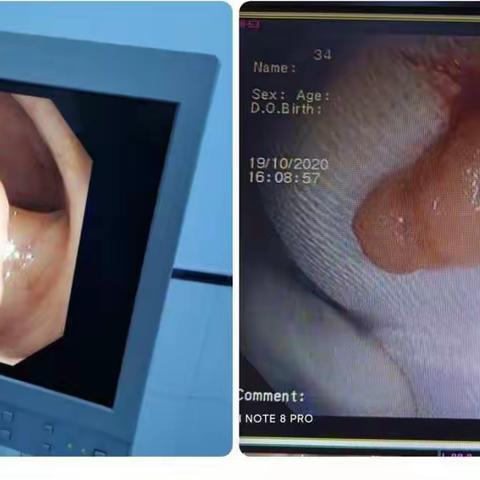 淳化县医院开展内镜下息肉摘除术