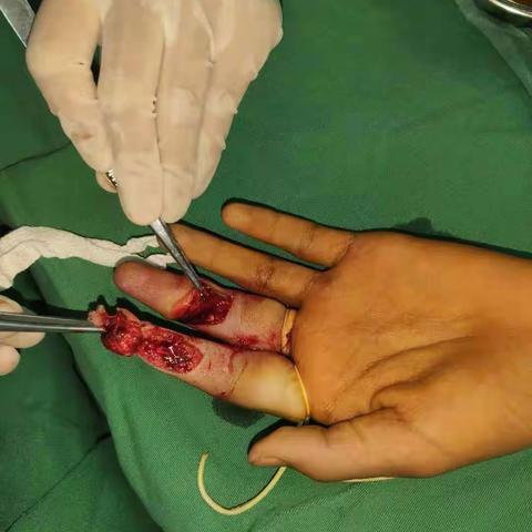 不忘初心，追梦前行——万年县人民医院急诊科成功开展多例显微外科重建手术