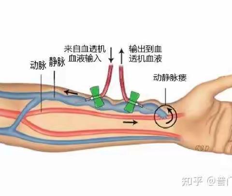 建立动静脉内漏术后要如何锻炼