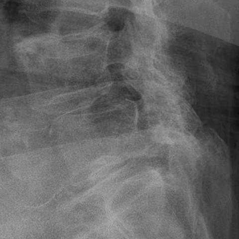 【优质服务创新年】骨科机器人施妙术 患者腰腿疼速缓解