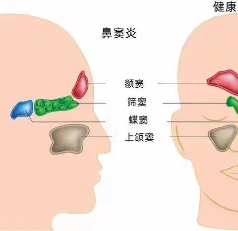 儿童鼻窦炎【科普】