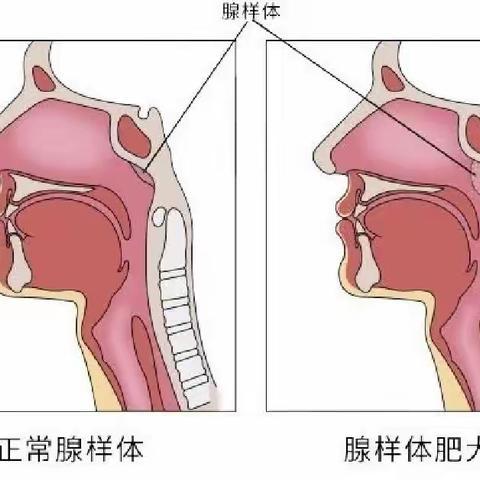 腺样体虽小，危害可不小【科普】