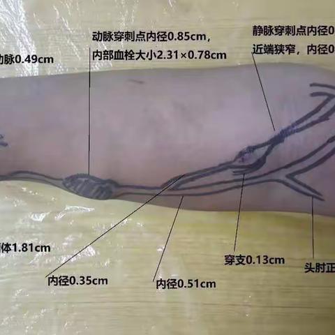 一口通两道的手术方案设计