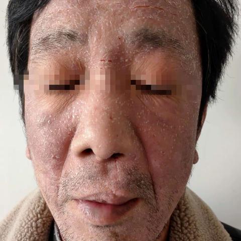 千里路上寻医，只为解决皮肤之痒