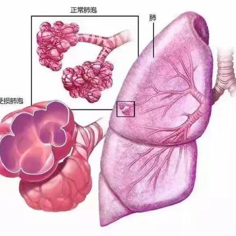 体检发现“肺大疱”怎么办？