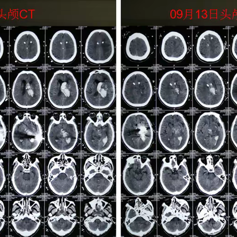 救治危重脑出血患者，我们一直在路上！